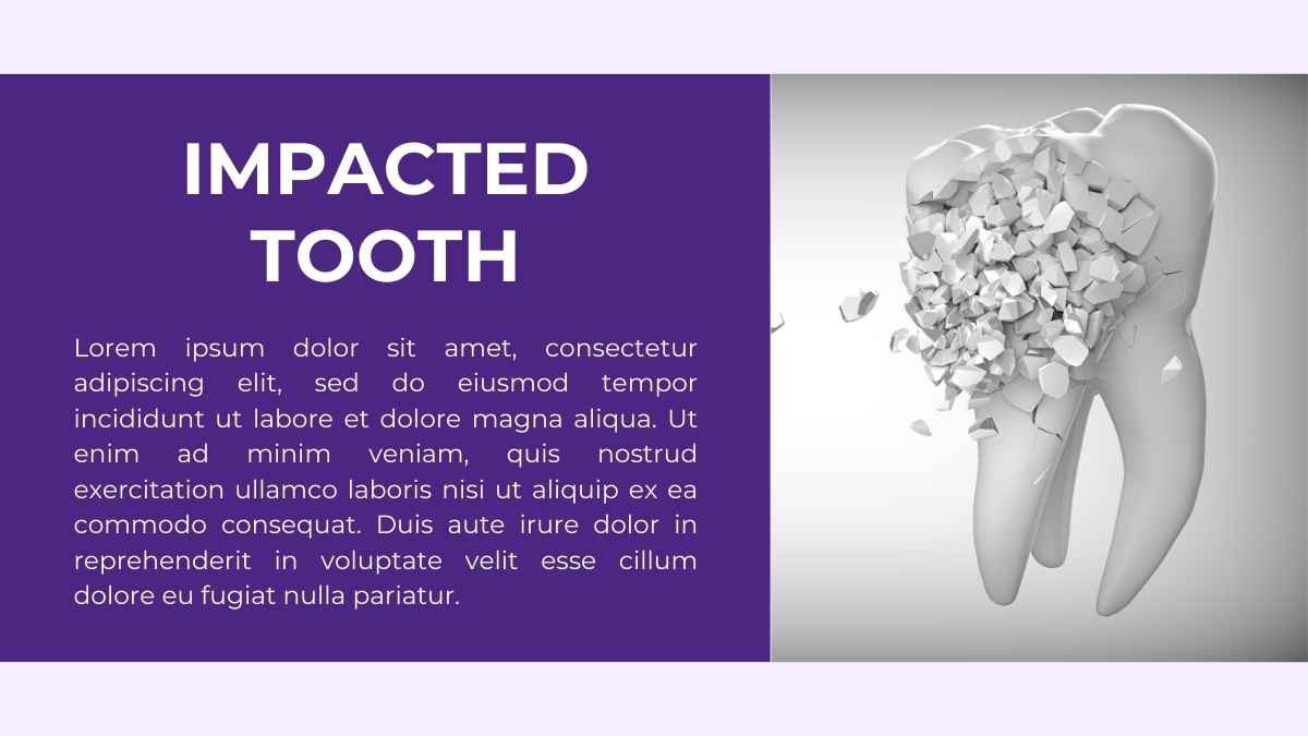 Simple Impacted Wisdom Teeth Slides - slide 4